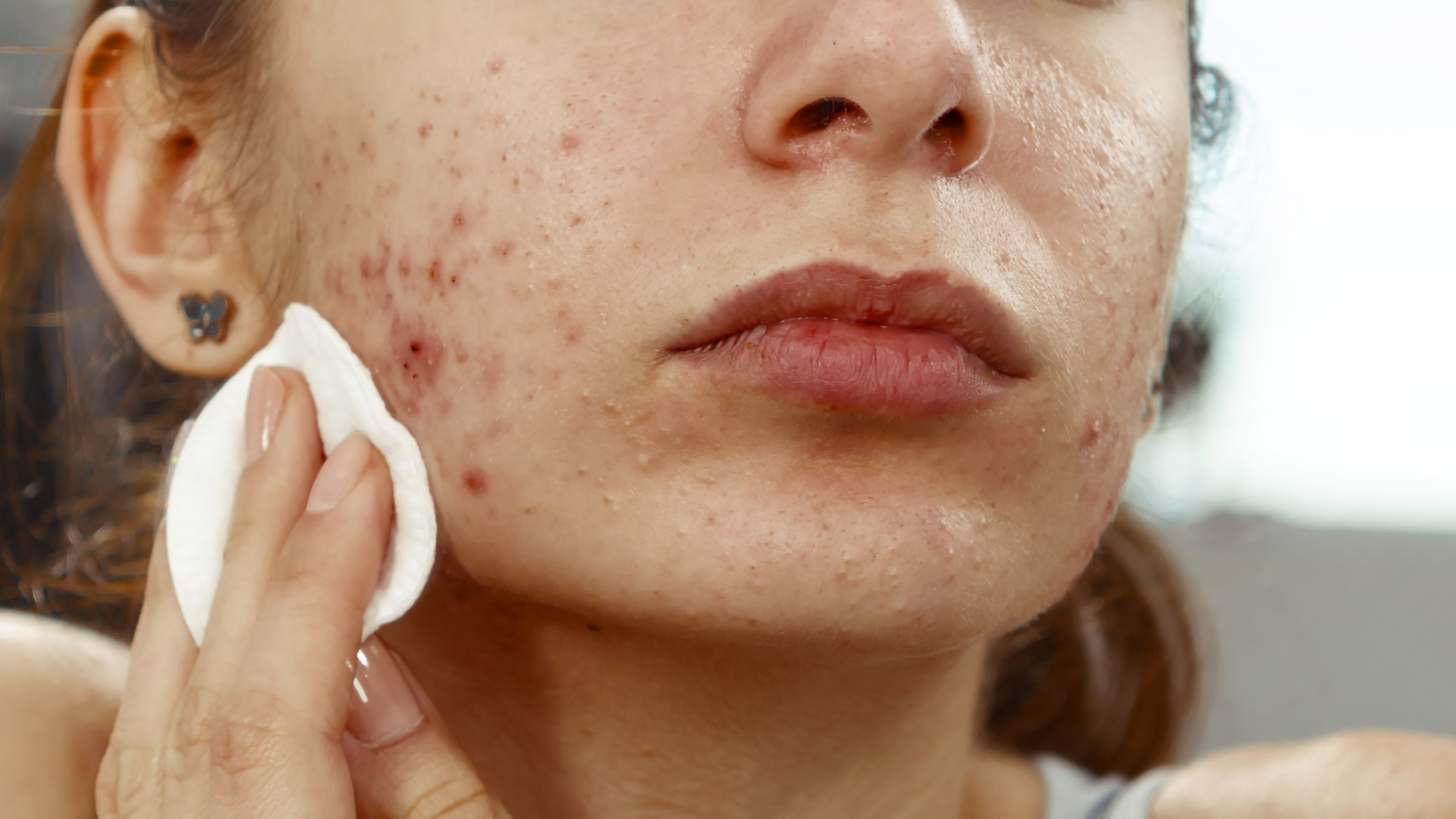 7 Tips Menangani Jerawat Hormonal dengan Cara Alami