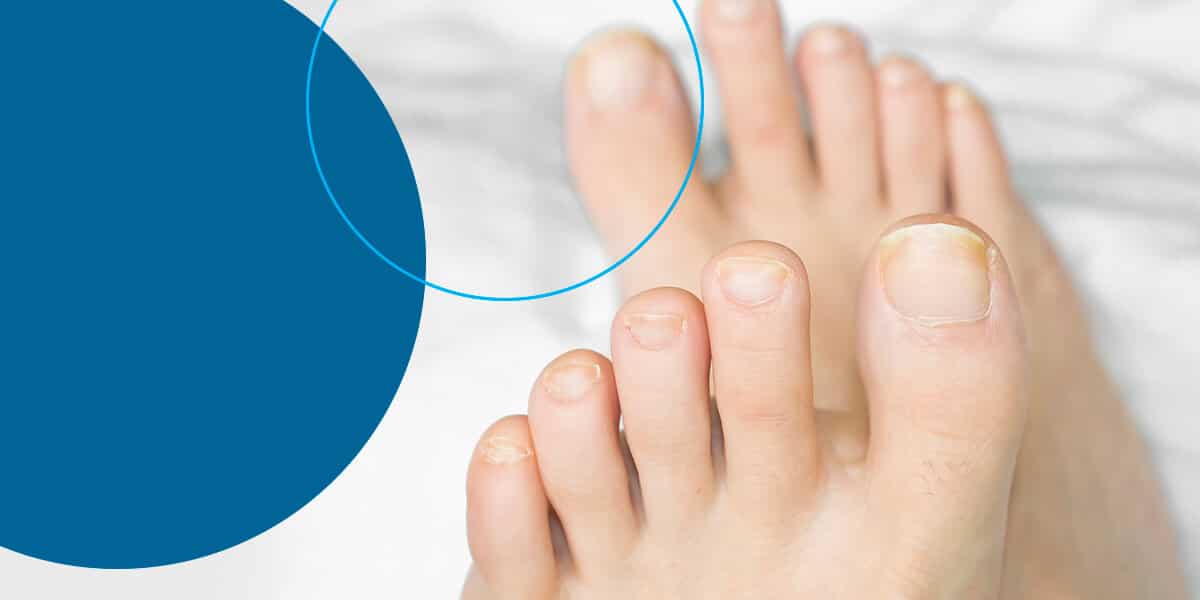 7 Langkah Merawat Kuku Kaki agar Tidak Mudah Infeksi